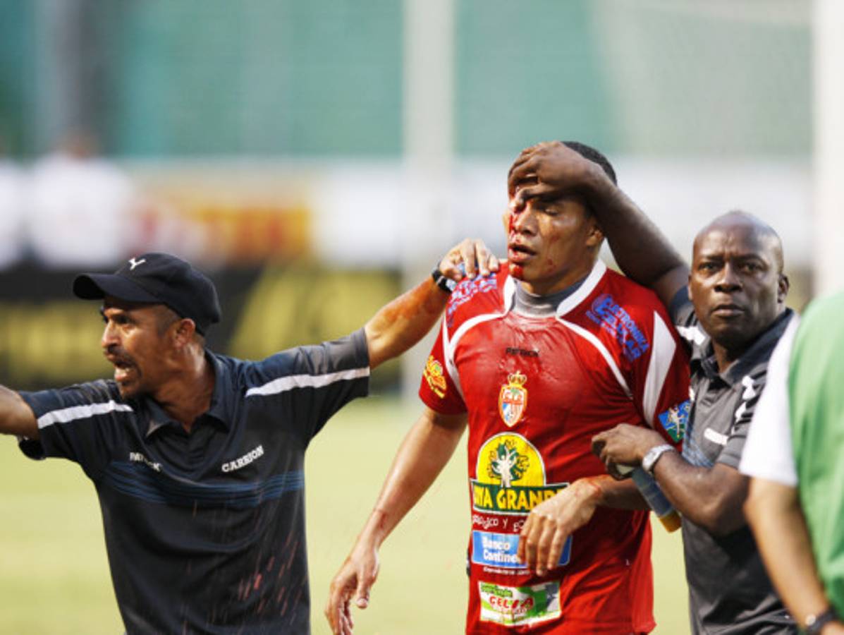 FOTOS: Rambo termina ante Olimpia con el rostro ensangrentado