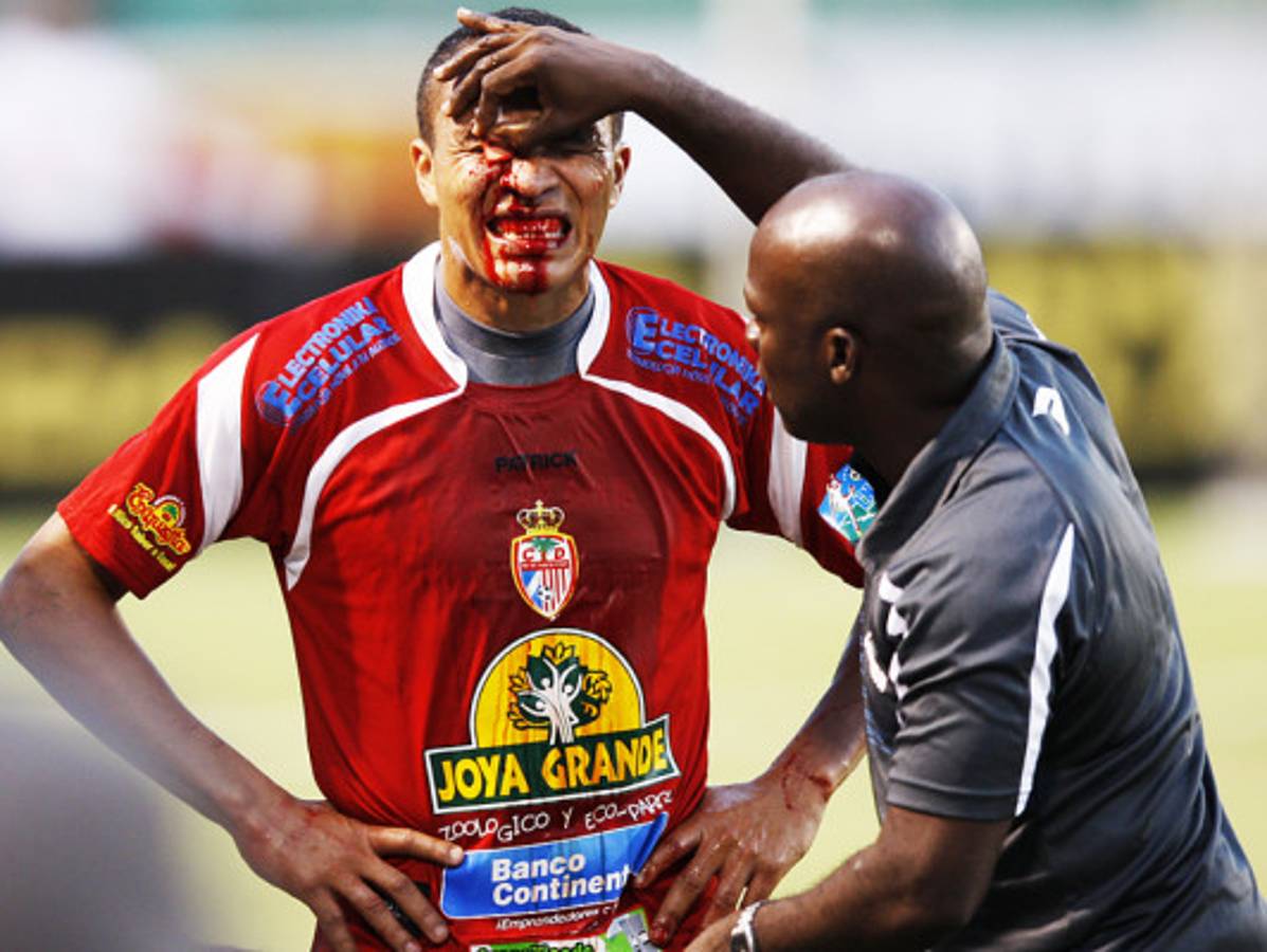 FOTOS: Rambo termina ante Olimpia con el rostro ensangrentado