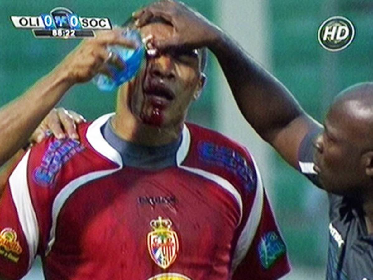 FOTOS: Rambo termina ante Olimpia con el rostro ensangrentado