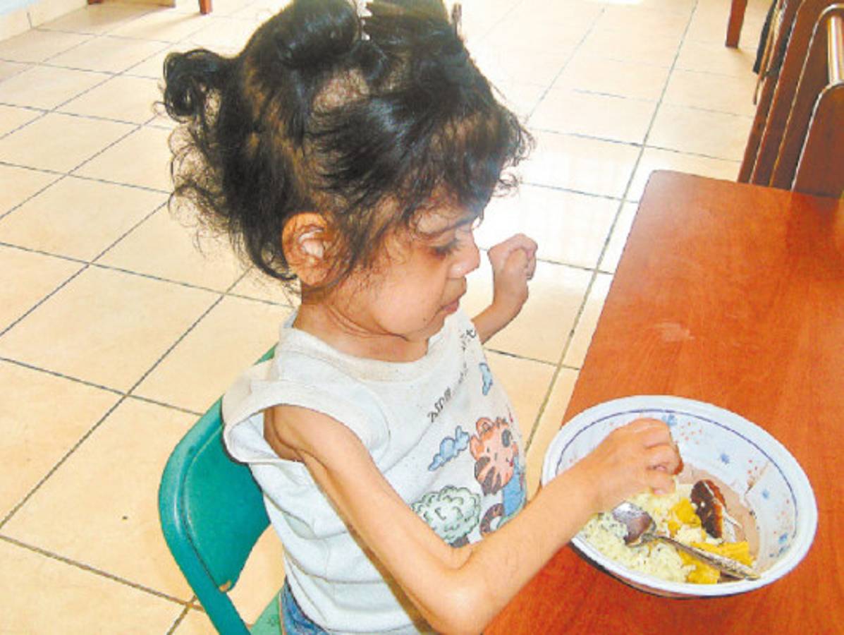 Niña hondureña de 15 años con desnutrición severa recibe ayuda