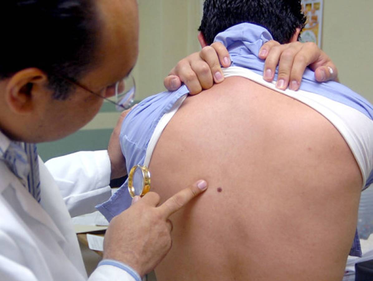 Comienzan evaluaciones de lunares cancerosos