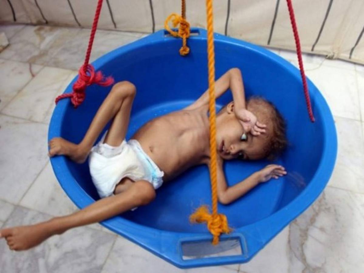 Ghazi Saleh, el rostro del hambre en Yemen