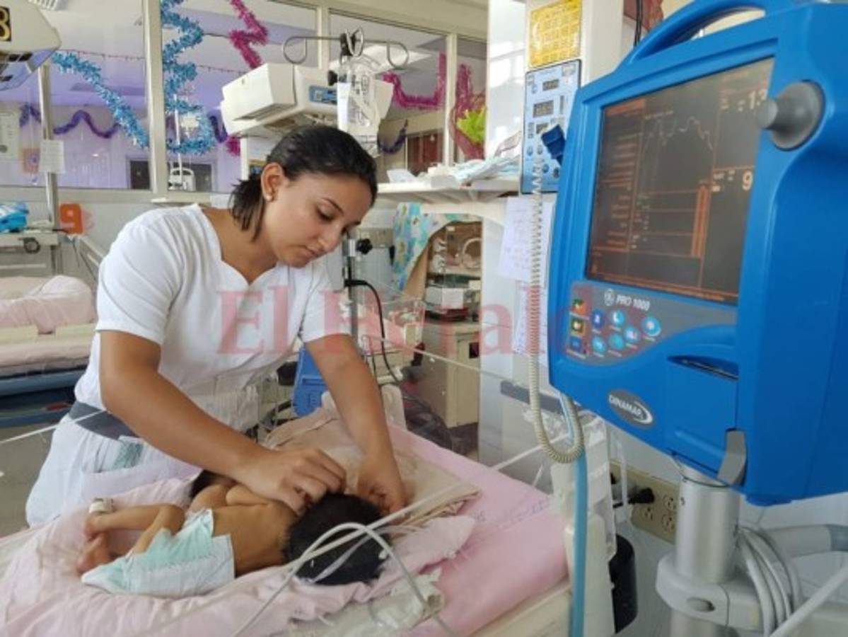 Muere bebé que nació con su gemela parásito unida al estómago