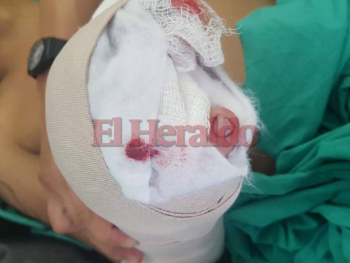 Joven de 26 años pierde dos dedos de una mano al manipular pólvora en la capital de Honduras
