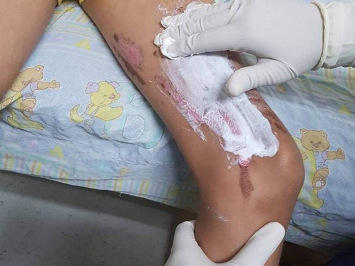 Es preocupante que los casos de quemaduras por manipulación de pólvora vayan en aumento.