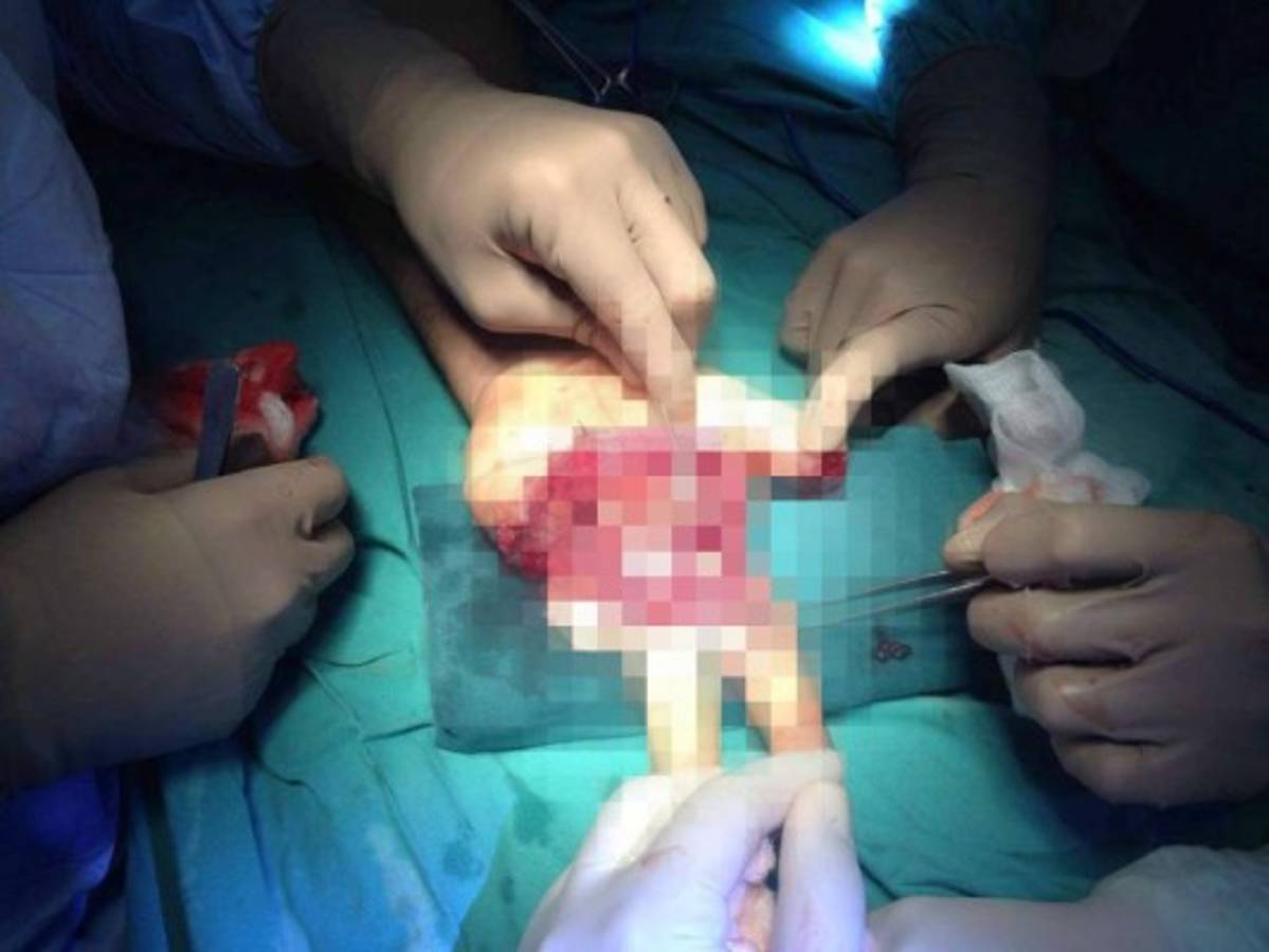 Cinco cirugías de mano más se sumarán a las ya realizadas en el HEU