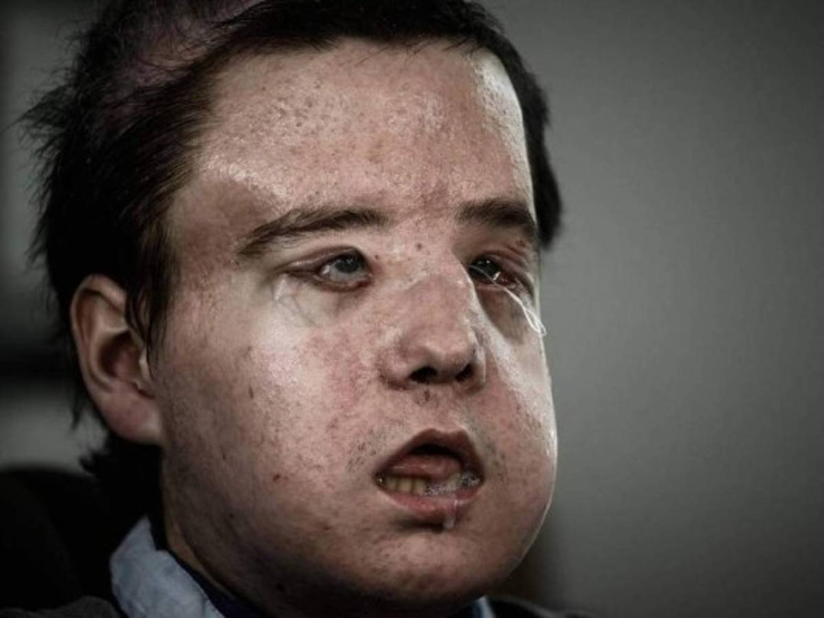 El hombre de las tres caras habla tras un nuevo trasplante