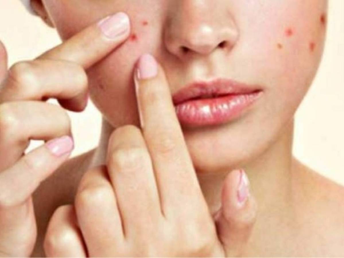 Cinco remedios caseros para acabar con el acné