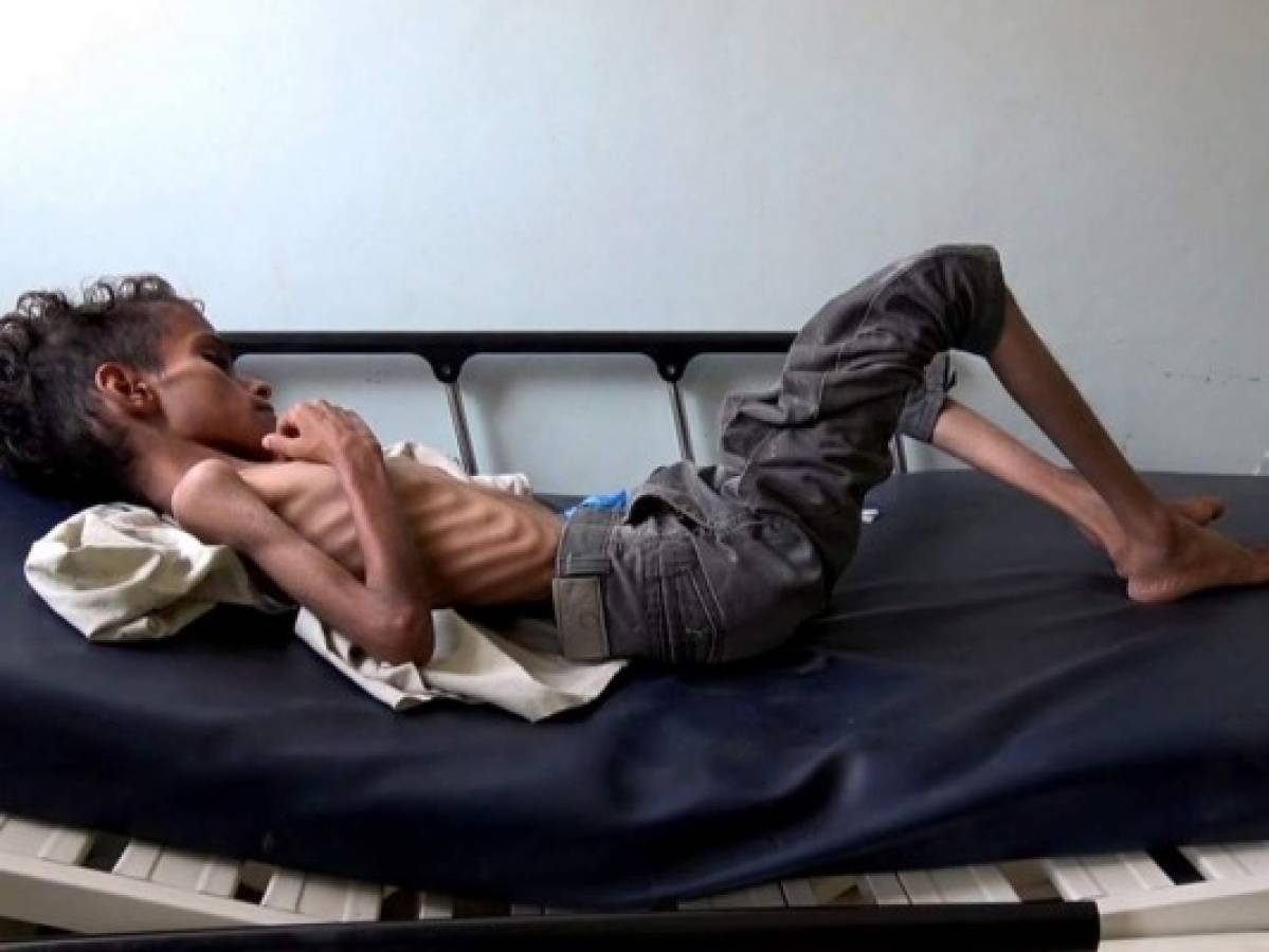 Ghazi Saleh, el rostro del hambre en Yemen