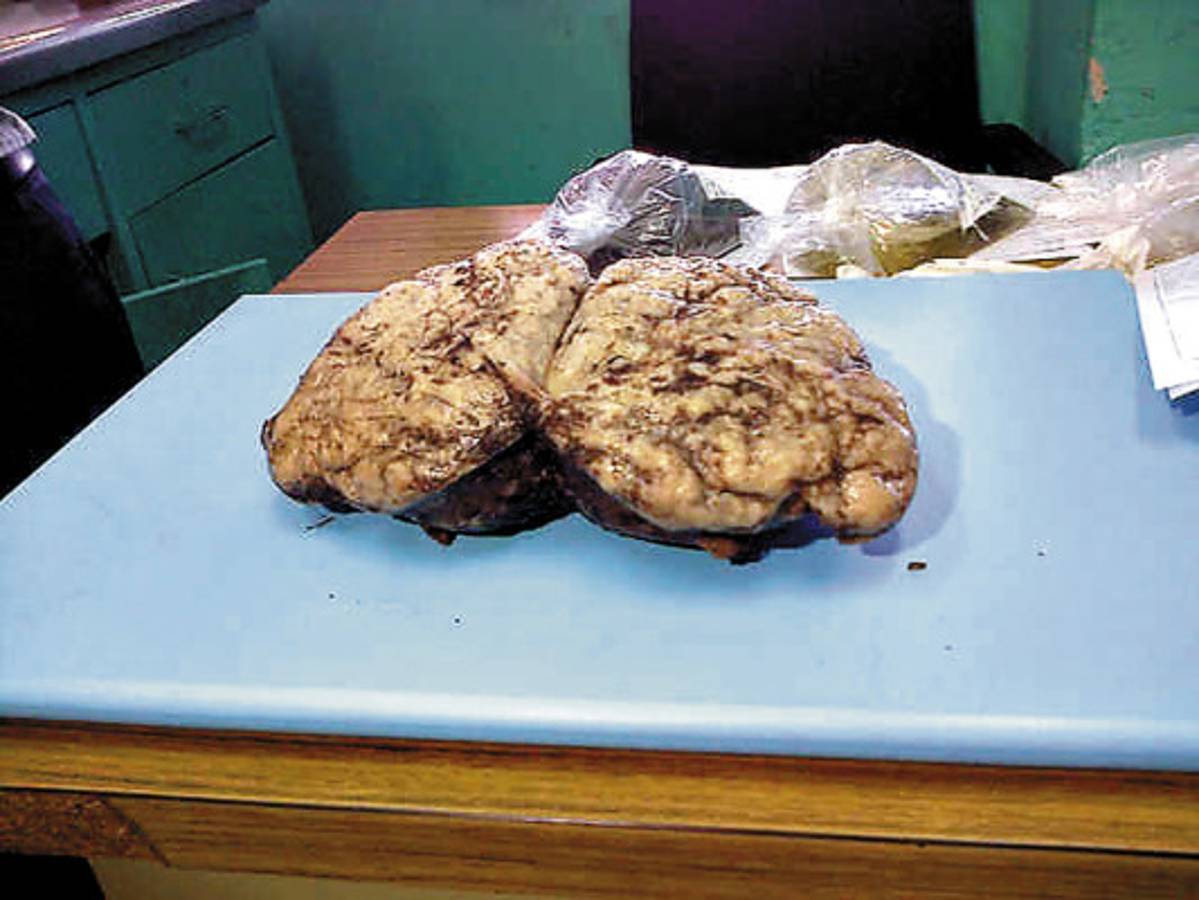 Honduras: Extraen tumor de seis libras a mujer