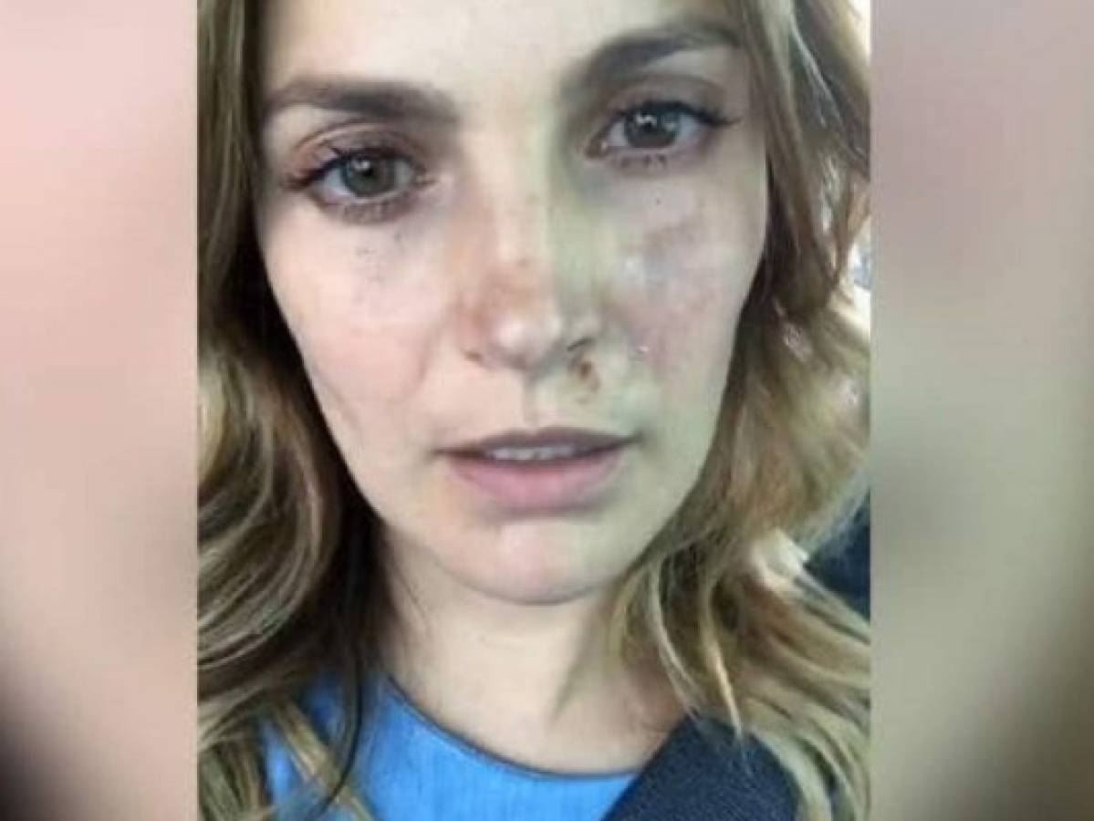 VIDEO: Con el rostro herido, famosa actriz colombiana reporta que sobrevivió sismo de 7.1 en México
