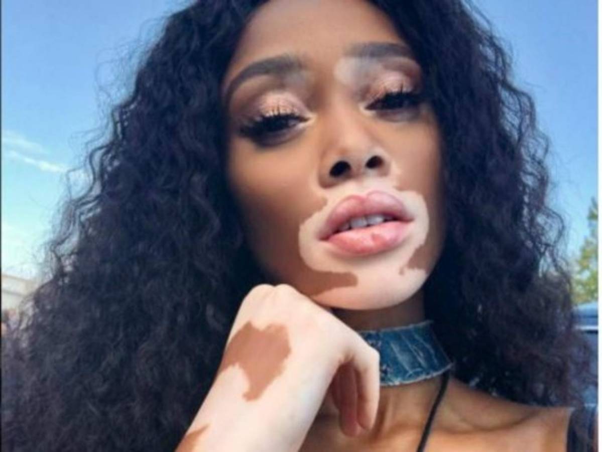Modelo con vitíligo muestra su cuerpo al natural y causa furor