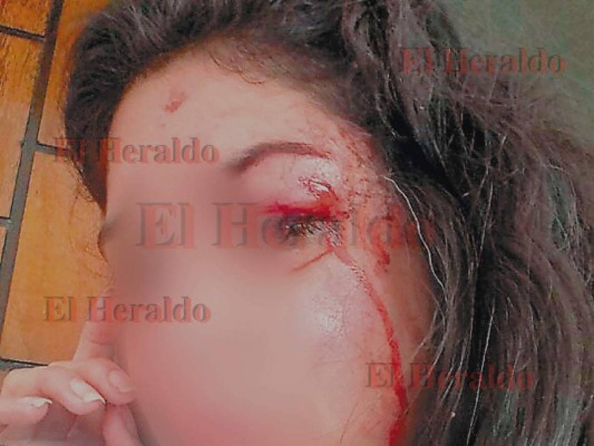 La estudiante tendrá que someterse a una reconstrucción ósea debido a los golpes.