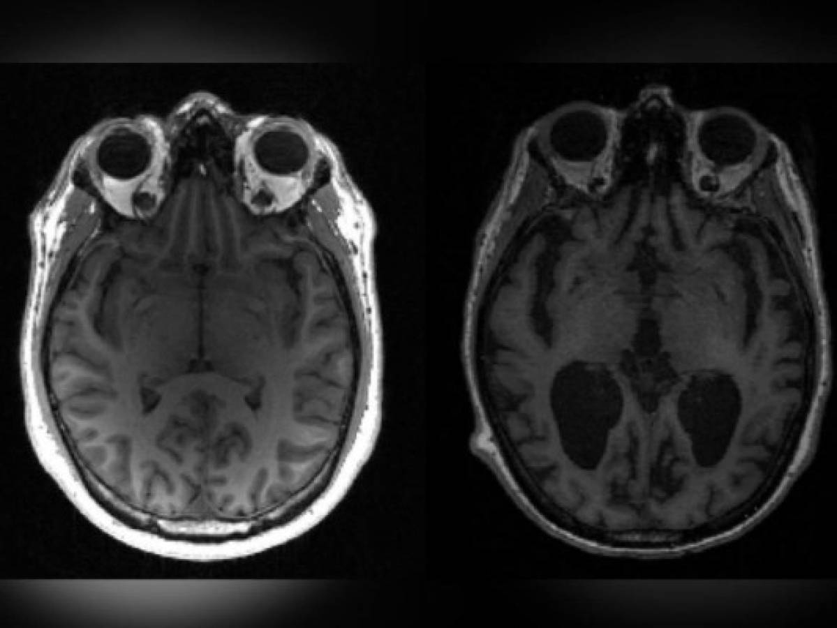 Investigadores identifican a un virus como detonador de la esclerosis múltiple