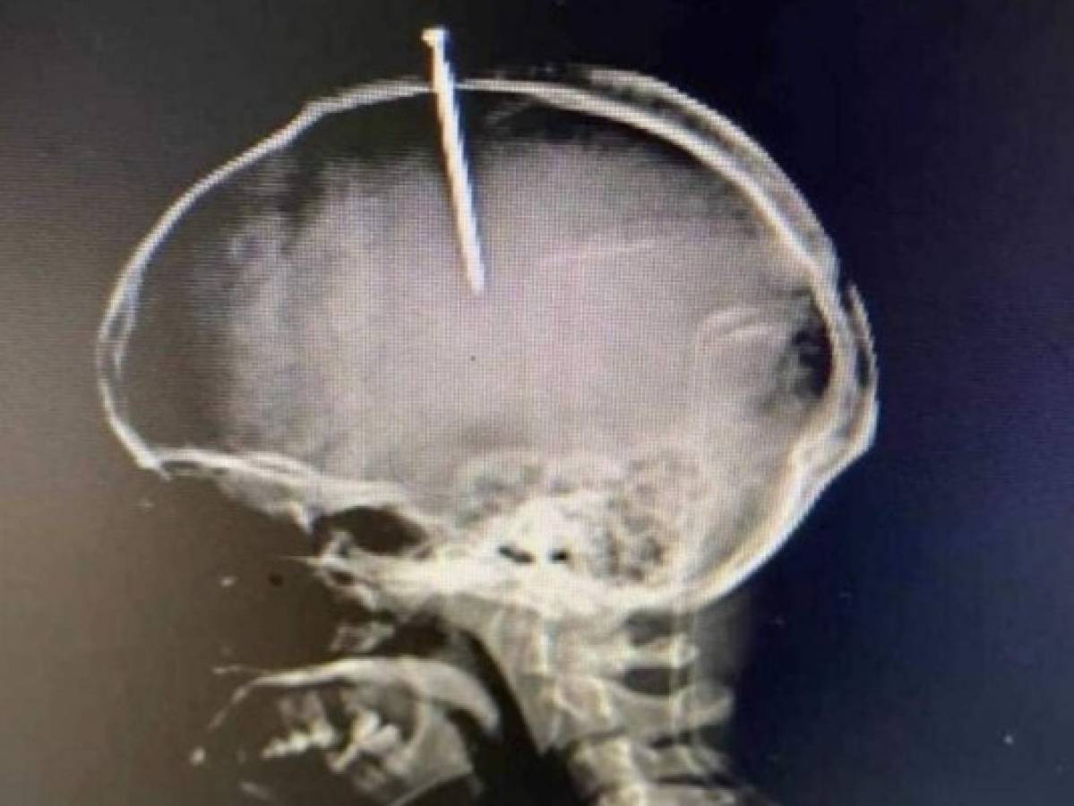 Hombre se incrustó un clavo en la cabeza porque sentía el 'cerebro flojo'
