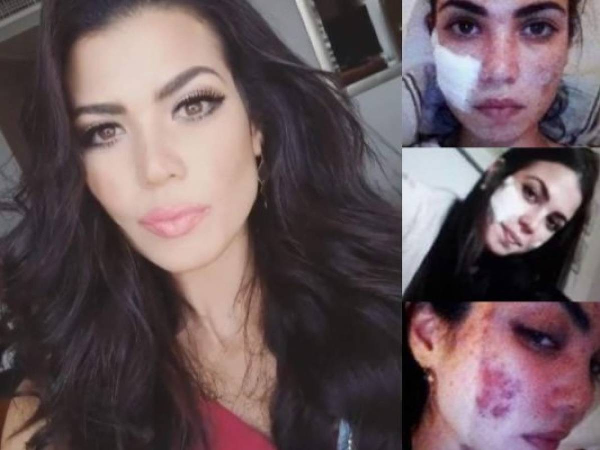Andrea Díaz, Miss Chile, fue quemada con ácido durante tratamiento de belleza