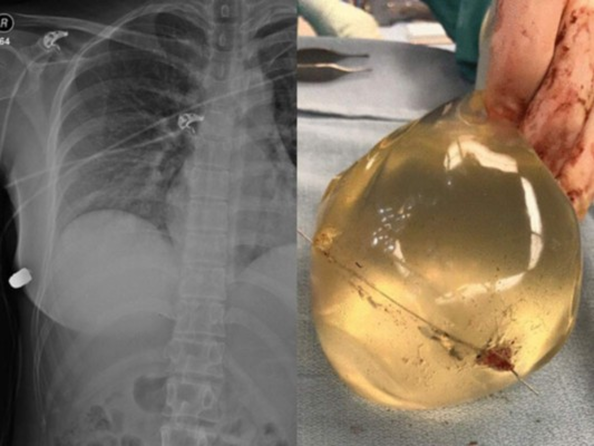 Implante de mama desvía bala y le salva la vida a una mujer