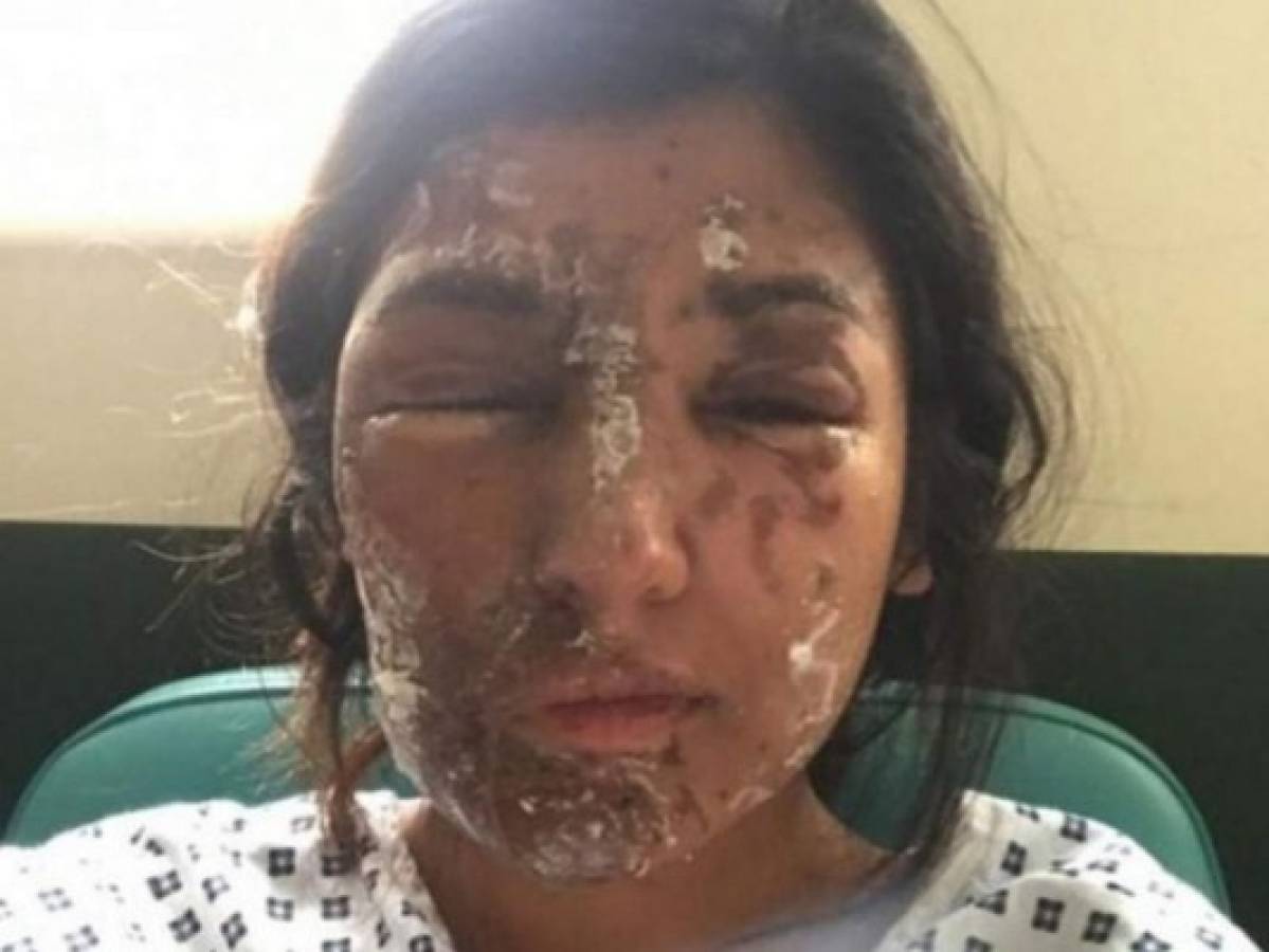FOTOS: Joven muestra su rostro tras recuperarse de ataque con ácido