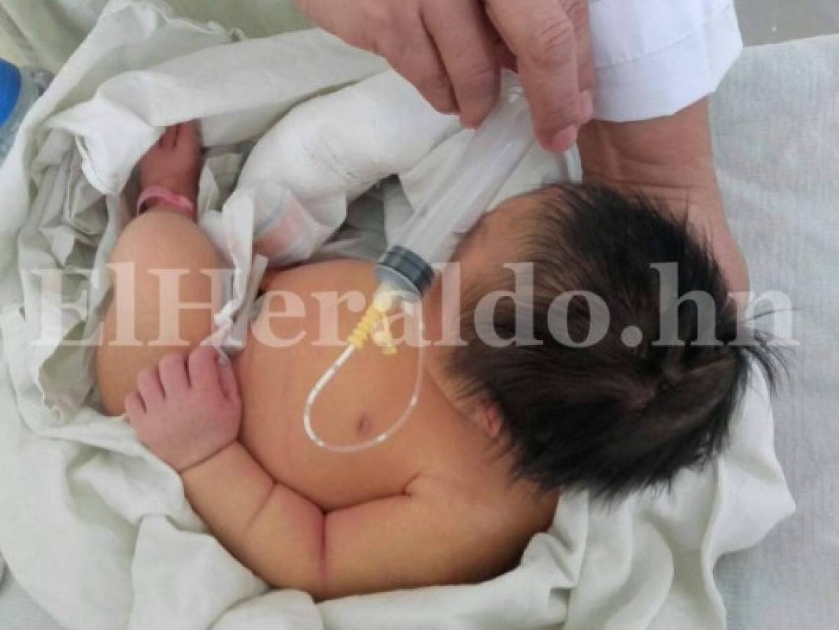 Uno de los recién nacido con microcefalia presenta además pie equinovaro (Foto: Mario Urrutia/ElHeraldo).