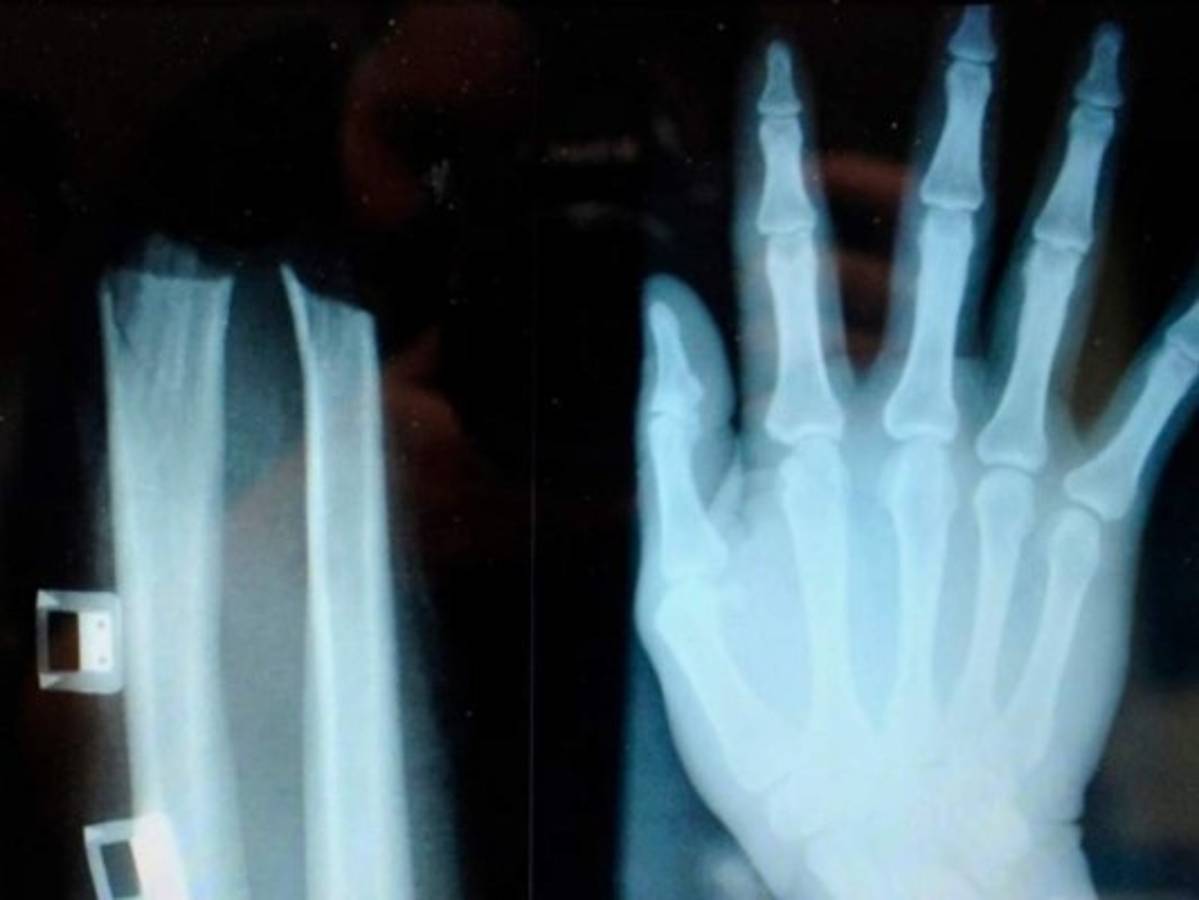 Dos años de cárcel para eslovena que se cortó la mano para cobrar el seguro