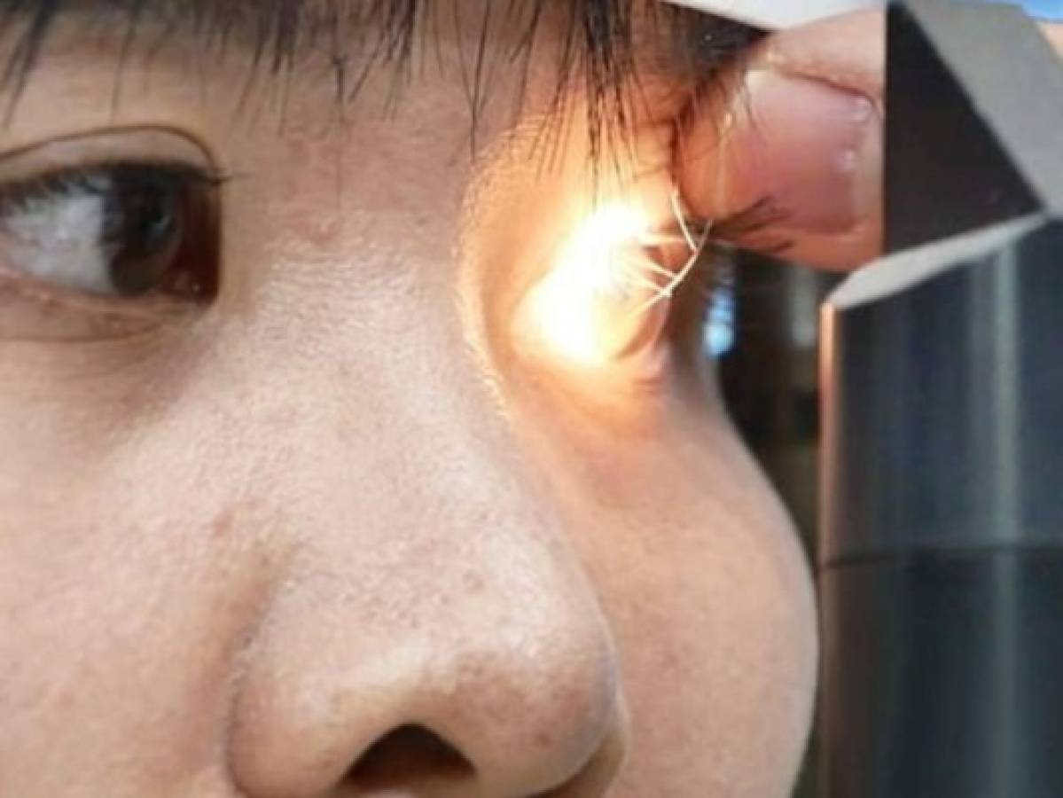 Hallan cuatro abejas vivas en el ojo de una mujer taiwanesa