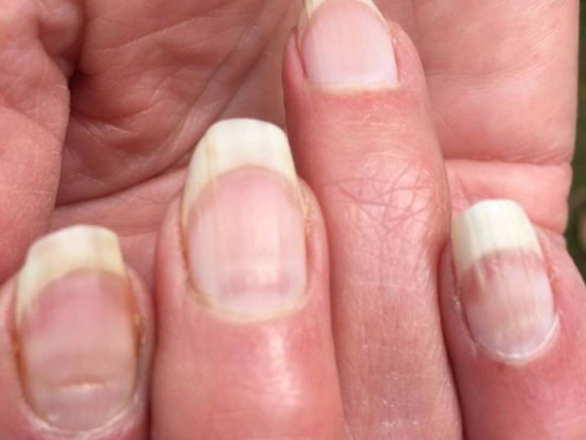 'Uñas covid', conoce cuáles son los cambios que indican una infección pasada  