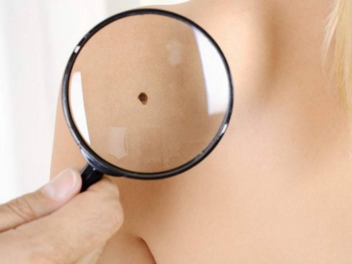 ¿En qué consiste la regla ABCDE de los lunares para prevenir el cáncer de piel?  