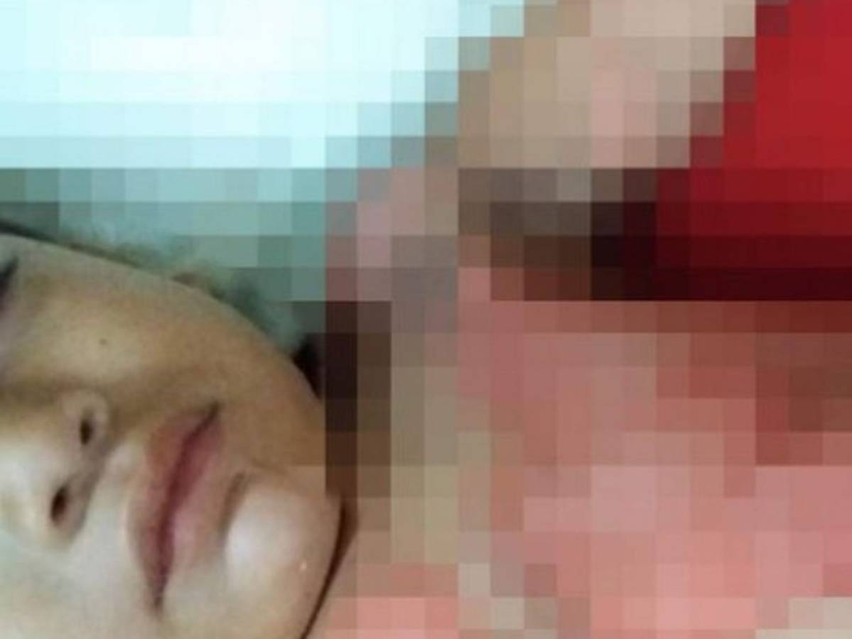 Menor resulta con graves quemaduras al caerle sopa instantánea encima