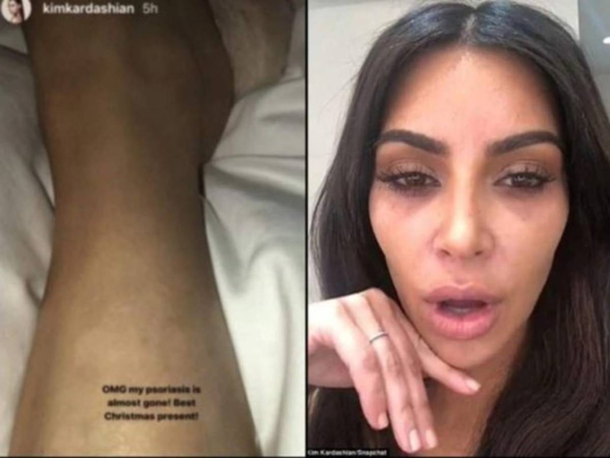 Kim Kardashian revela que la psoriasis que sufría en las piernas ya afectó su rostro