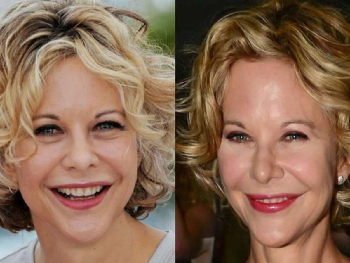 Famosos que lucen terribles después de las cirugías