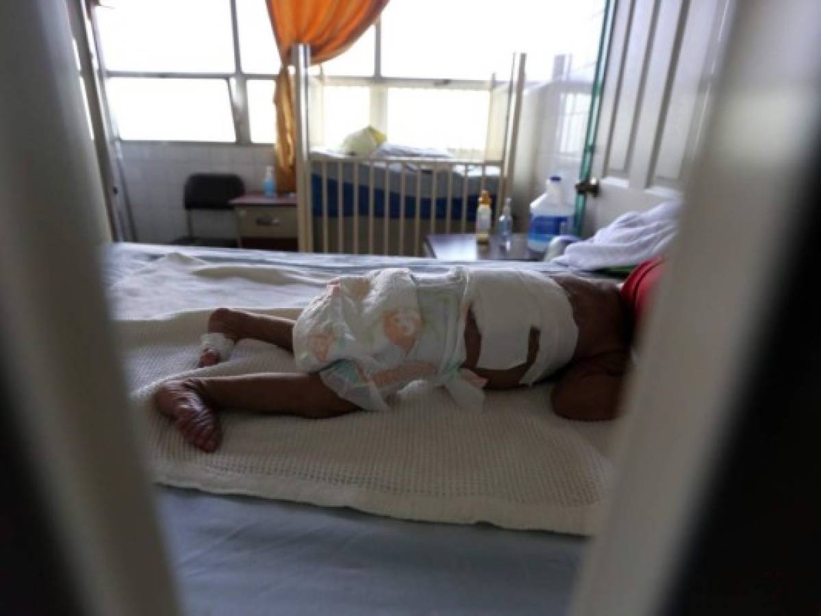Reportan muerte de un recién nacido a causa del hongo negro en Honduras