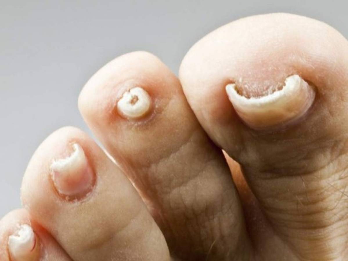 Ocho consejos para evitar la aparición de hongos en los pies