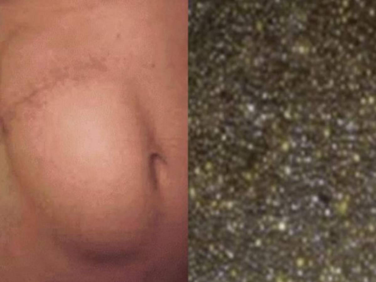 La historia de la mujer que tenía cinco mil piedras en su vesícula