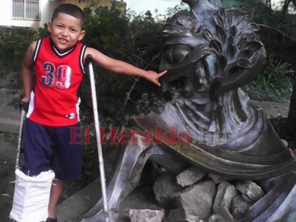 Joan fue víctima de bullying a la edad de seis años. Desde entonces se ha enfrentado a una dura recuperación. Así lucía su pierna derecha luego de someterse a la primera cirugía.