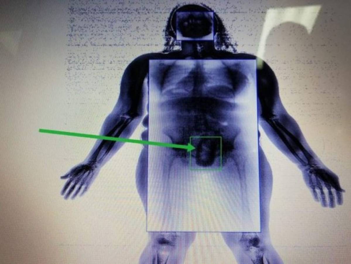 La máquina de escáner logra detectar absolutamente cualquier cosa que se lleva dentro del cuerpo.