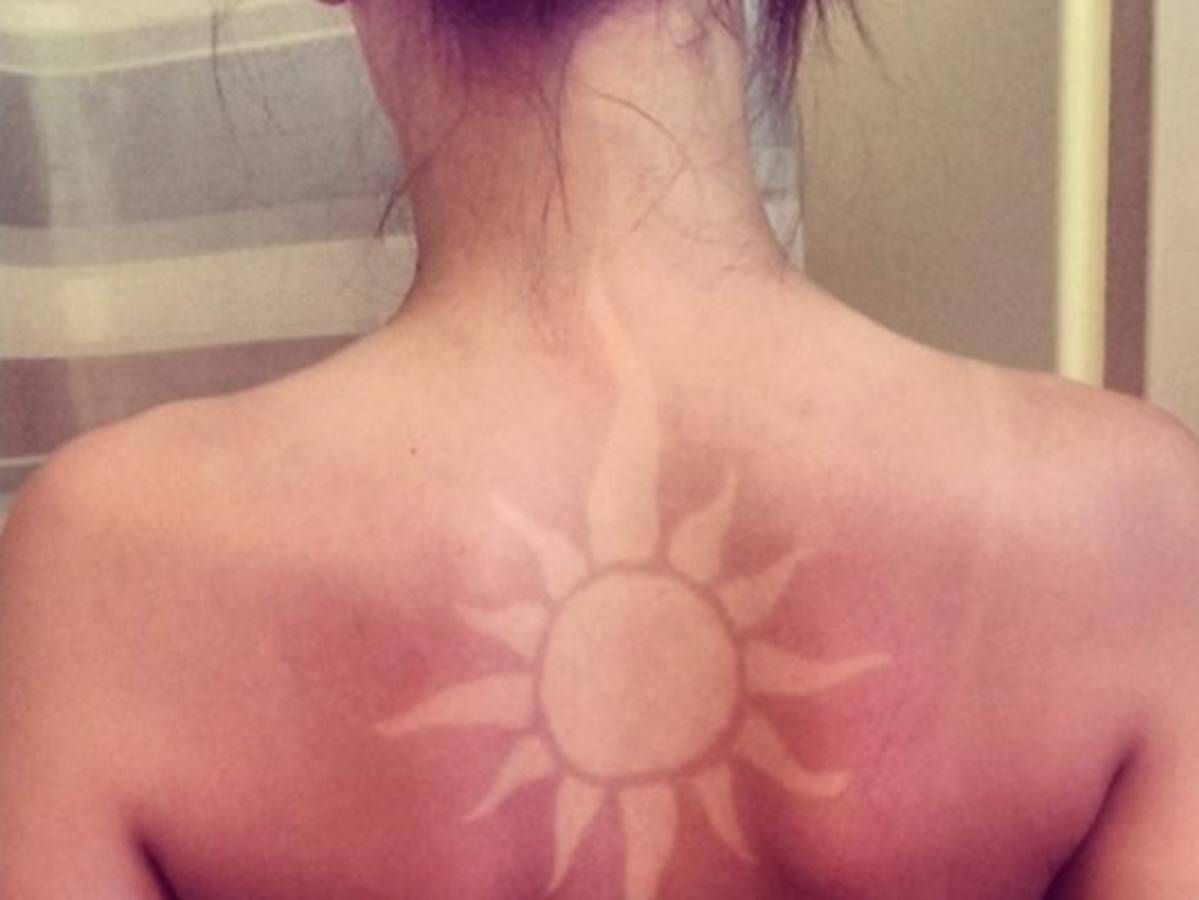 Tatuajes de Sol, la peligrosa tendencia que se apodera de las redes sociales&nbsp;&nbsp;
