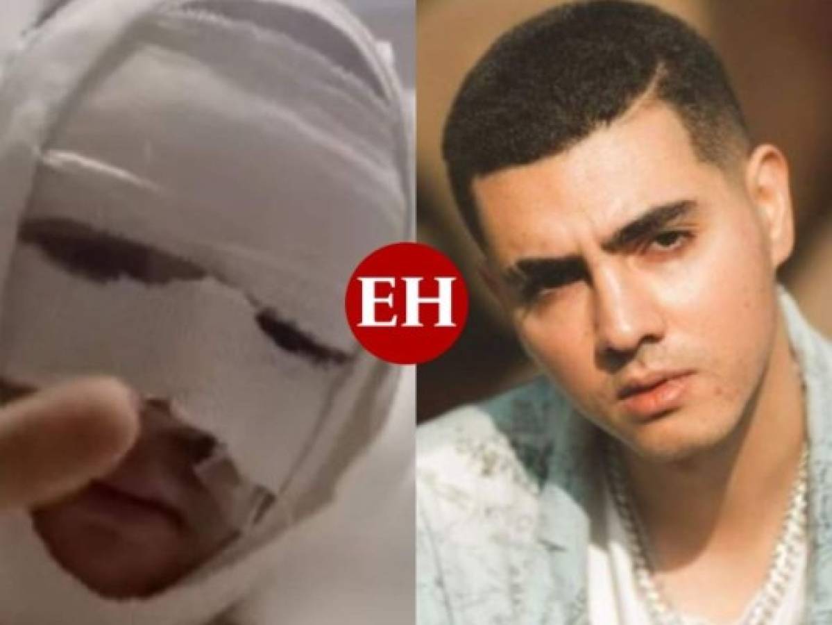 Actor mexicano sufre terribles quemaduras en su rostro tras explosión de gas