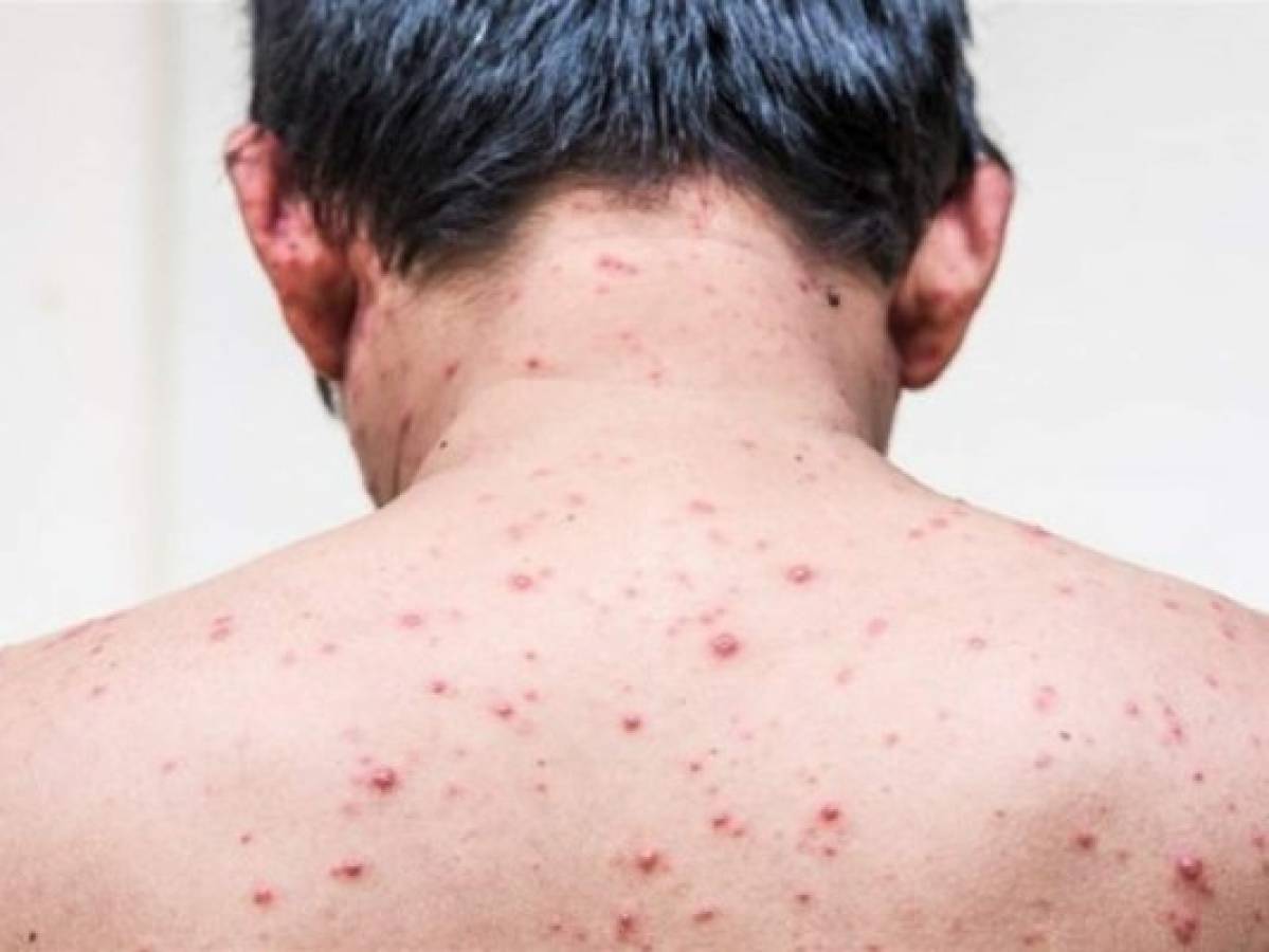 Cinco tips caseros para aliviar la comezón de la varicela