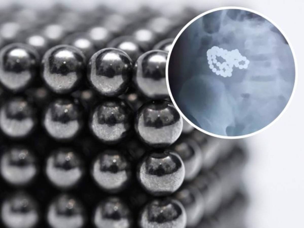 61 bolas magnéticas fueron extraídas del estómago de un niño  