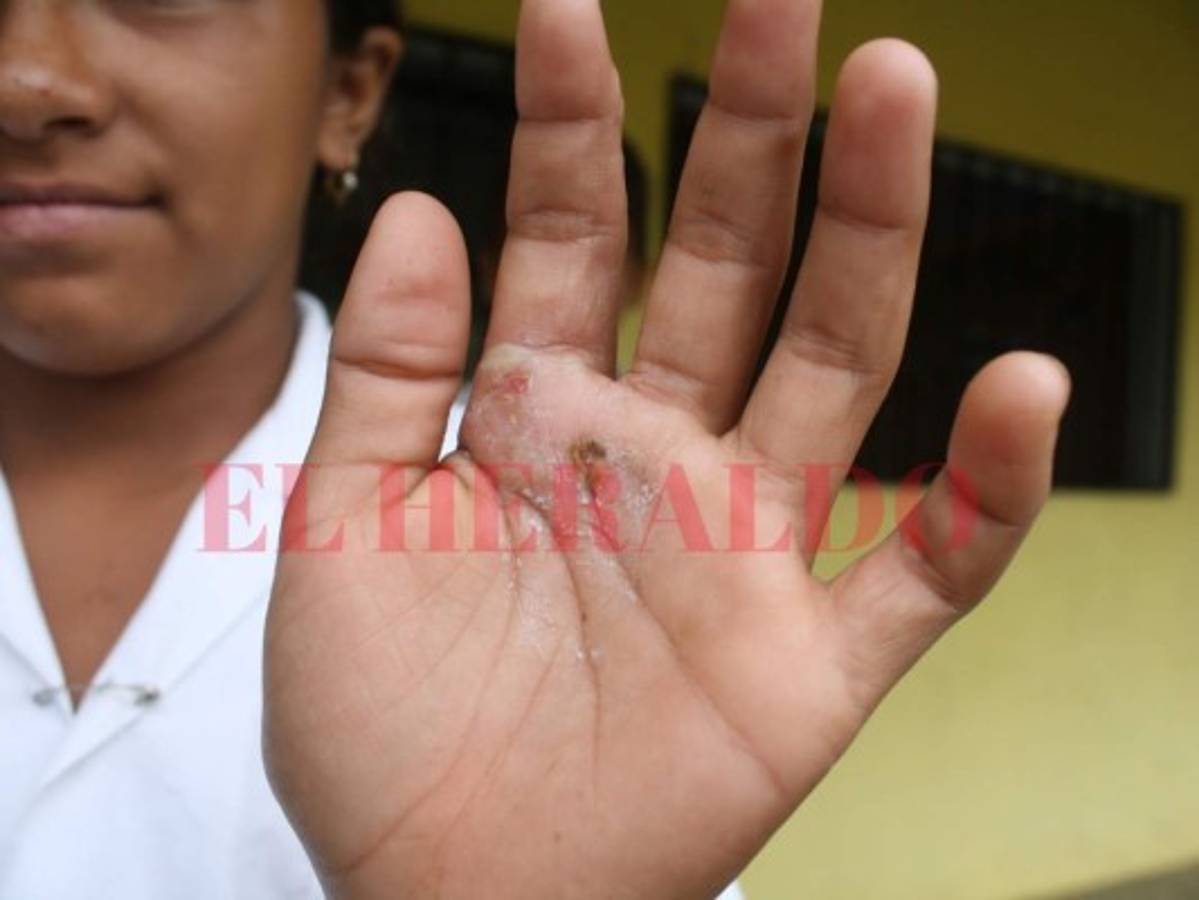 Lluvias aumentan las mordeduras de serpientes en oriente