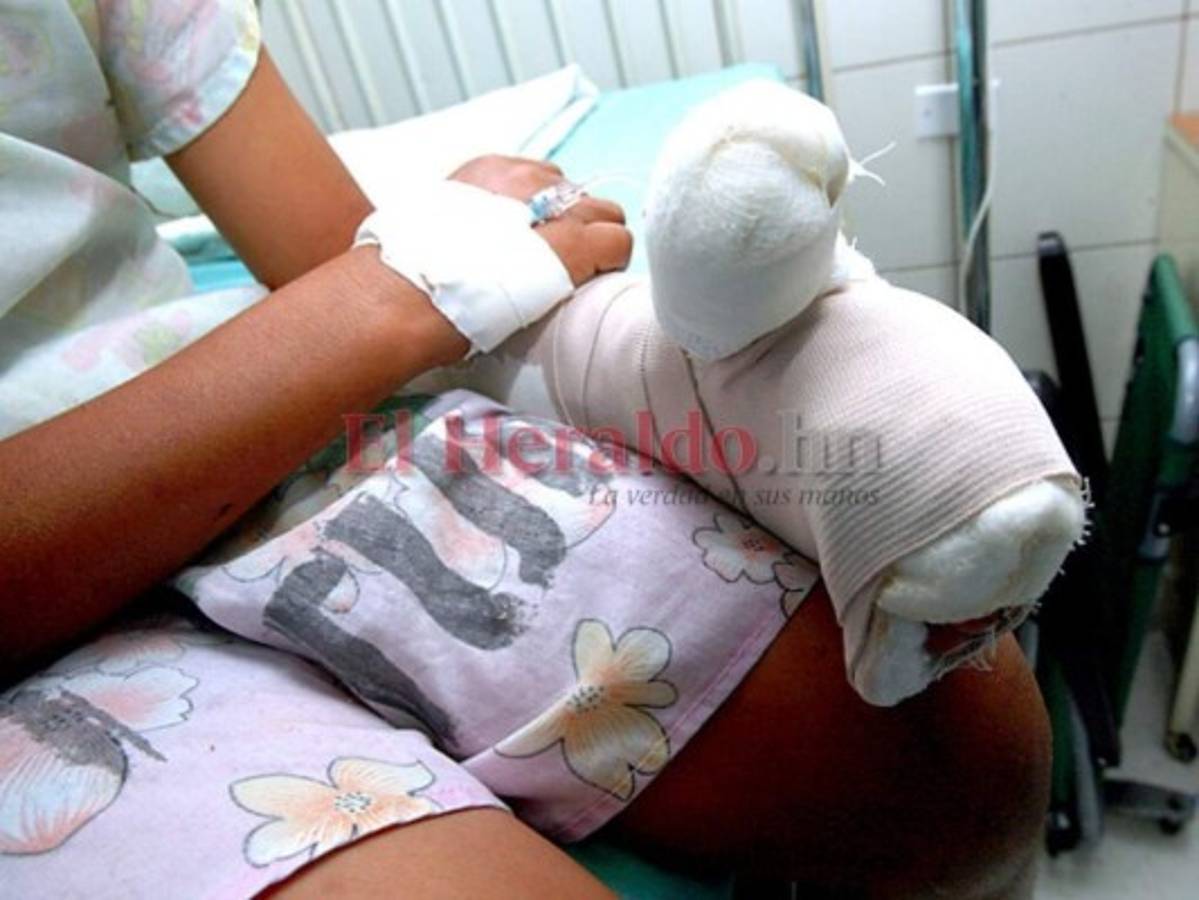 Unos 35 quemados por pólvora dejó Navidad y Año Nuevo