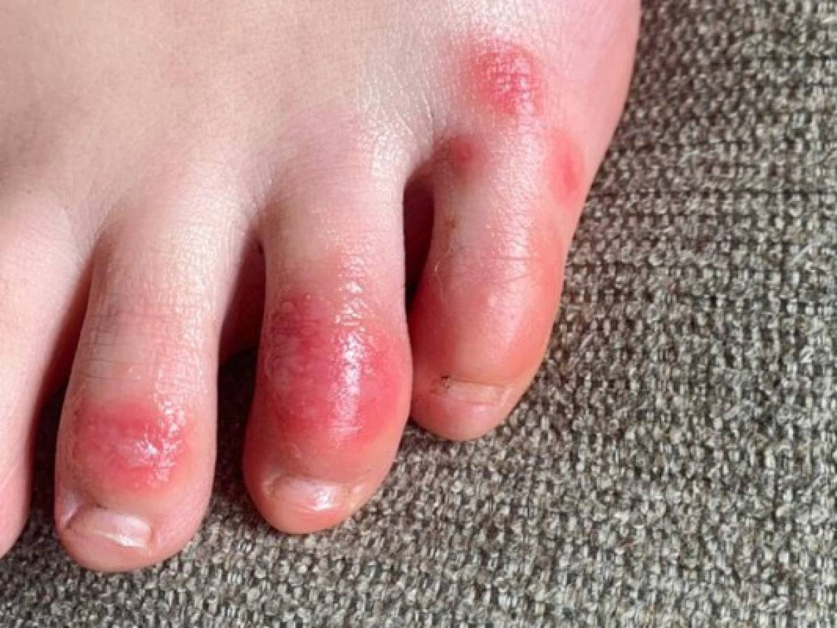 Erupciones en los dedos de los pies, otro síntoma del Covid-19