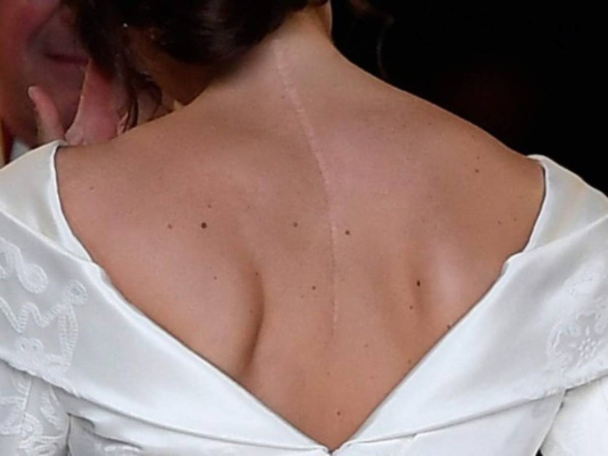 The scar on the back of Britain's Princess Eugenie of York is clearly visable as she arrives for her wedding to Jack Brooksbank at St George's Chapel, Windsor Castle, in Windsor, on October 12, 2018. (Photo by TOBY MELVILLE / POOL / AFP)