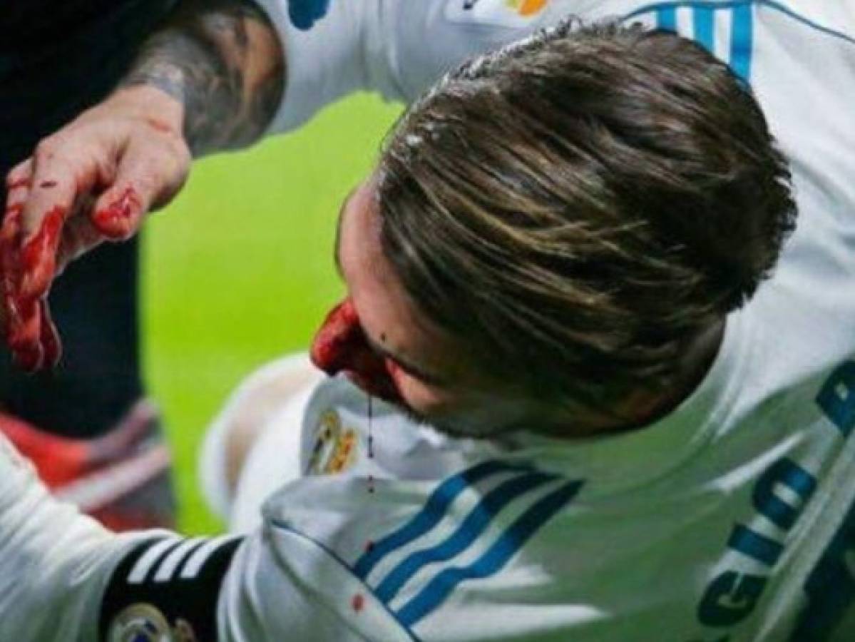Real Madrid confirma fractura de nariz de Sergio Ramos