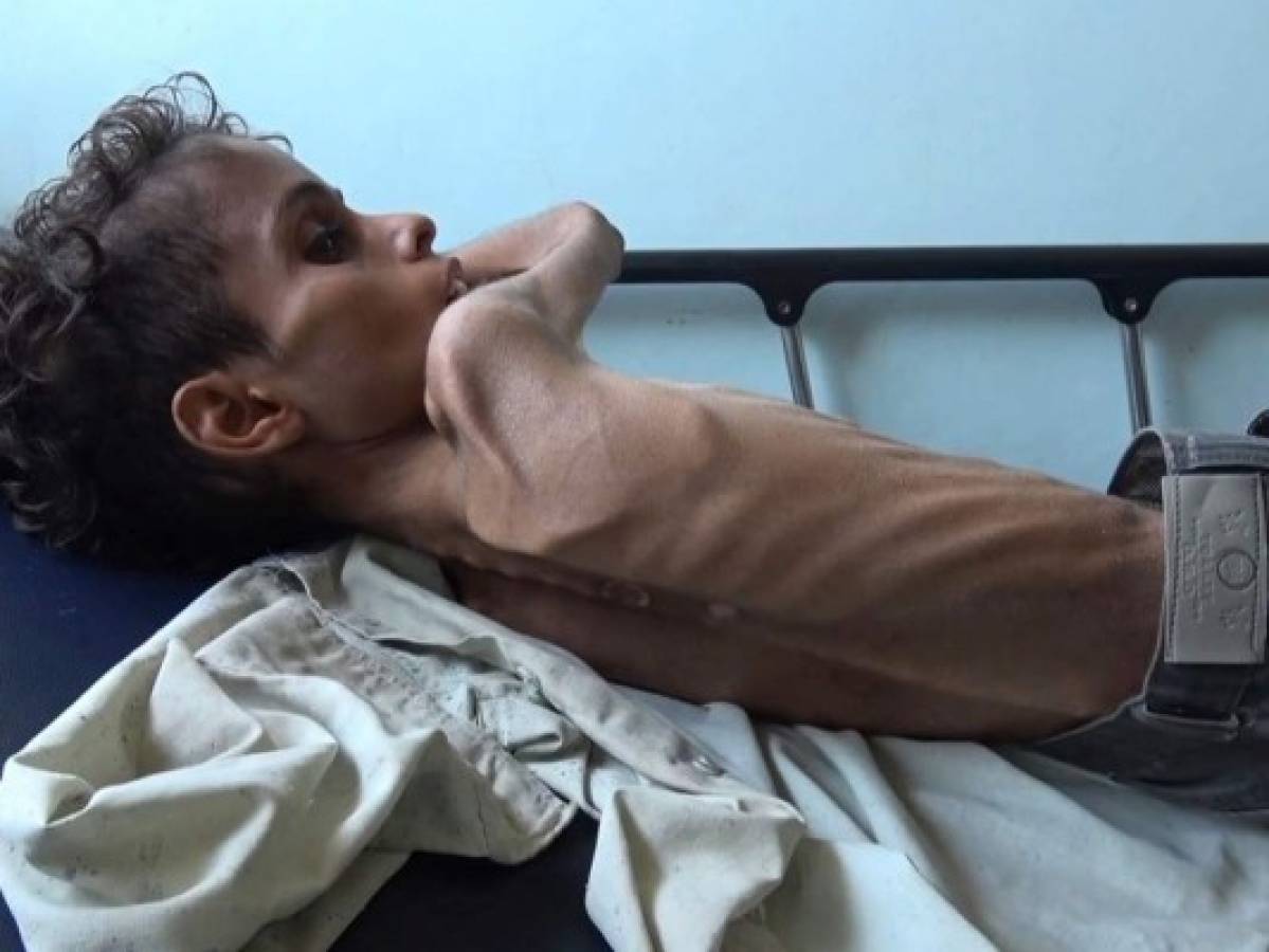 Ghazi Saleh, el rostro del hambre en Yemen