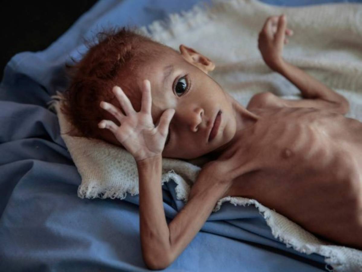 Yemen: Usan privación de alimentos como arma de guerra  