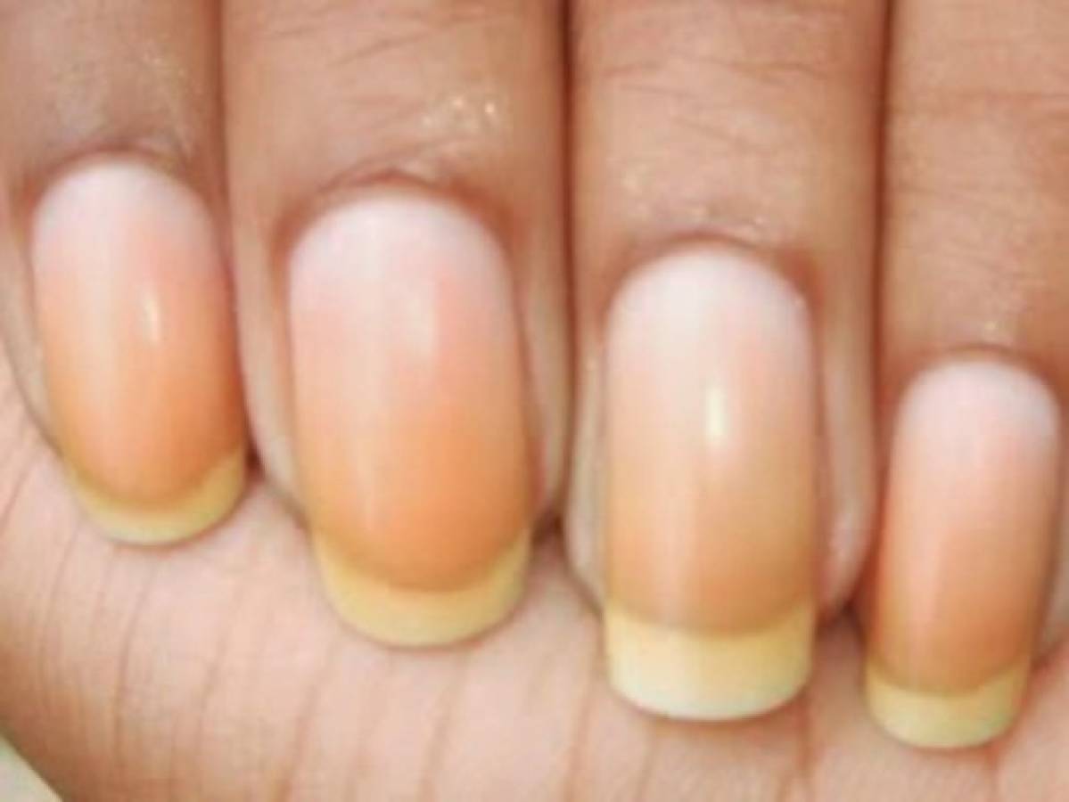 Las uñas amarillas pueden alertar sobre una posible diabetes.