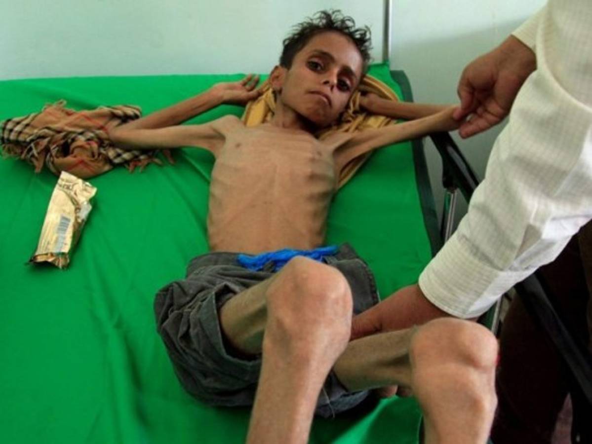 Ghazi Saleh, el rostro del hambre en Yemen