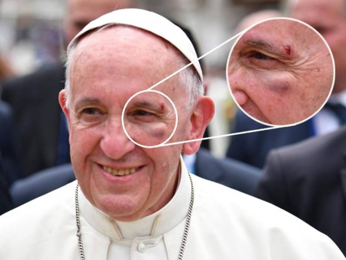 Francisco se hiere el rostro al golpearse contra el papamóvil en Colombia