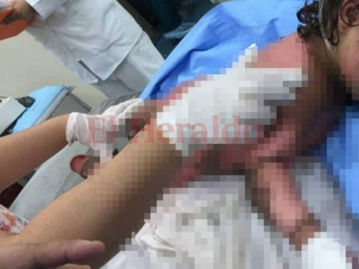 Abuela de niña quemada con chilate en Choluteca intentó curarla con manteca y pasta